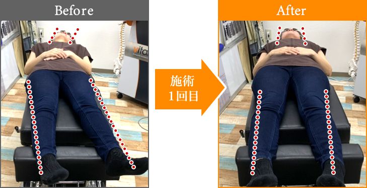 施術1回目