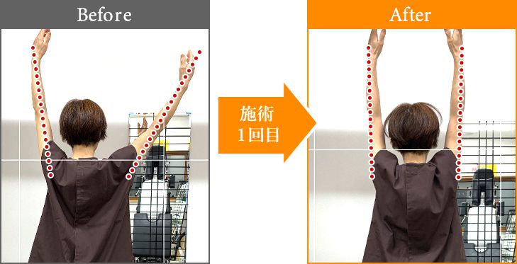 施術1回目